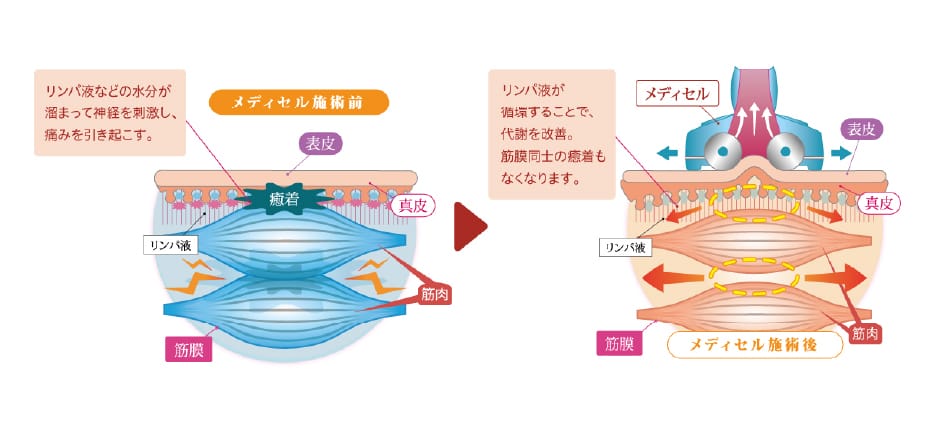 スポーツ治療イメージ3
